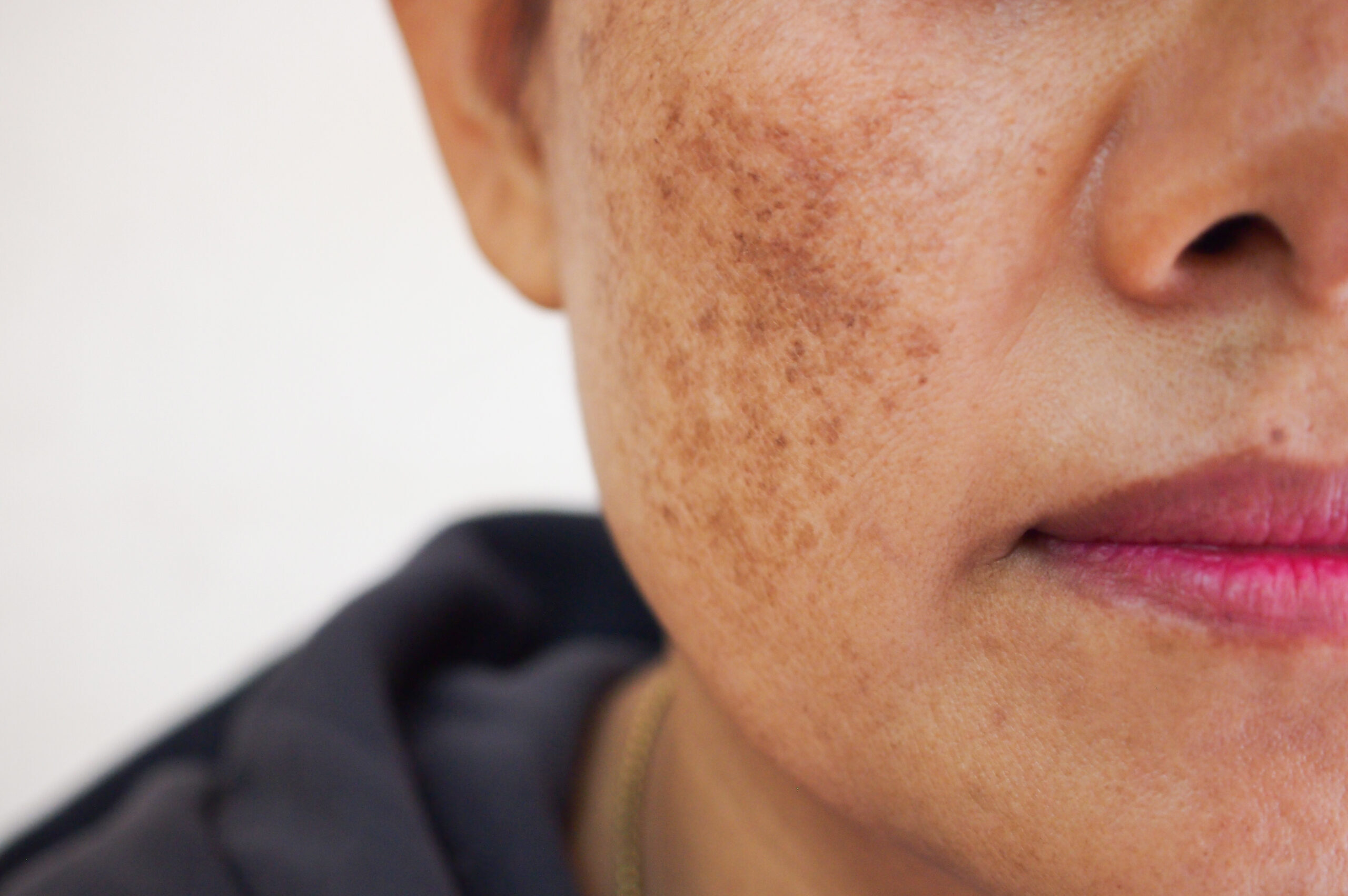 Laser Treatment of Pigmented Spots
