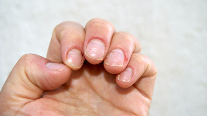 6 Common Nail Abnormalities and How to Treat Them