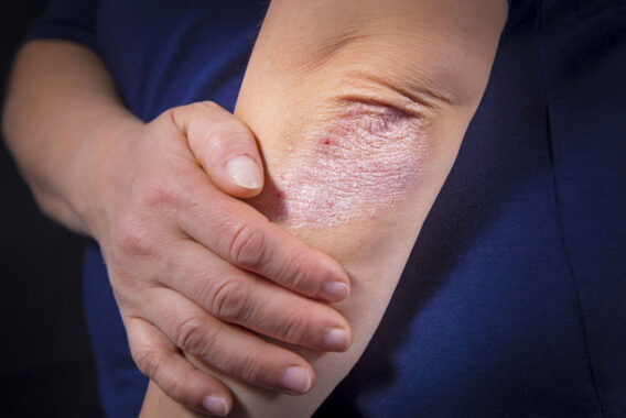 How to Find the Best Treatment for Your Psoriasis