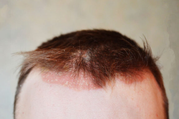 How to Treat Scalp Psoriasis at Home
