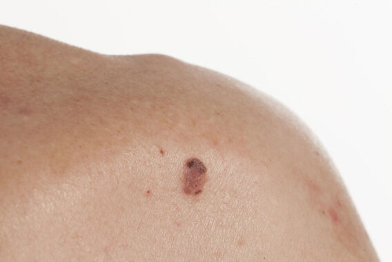 How to Spot the Symptoms of Squamous Cell Carcinoma