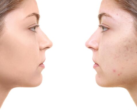Acne as a Teen? Try Dermaplaning