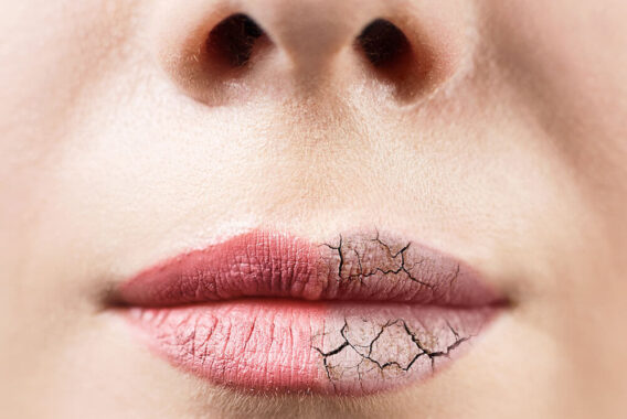 Avoid Dry, Chapped Lips With These 4 Tips