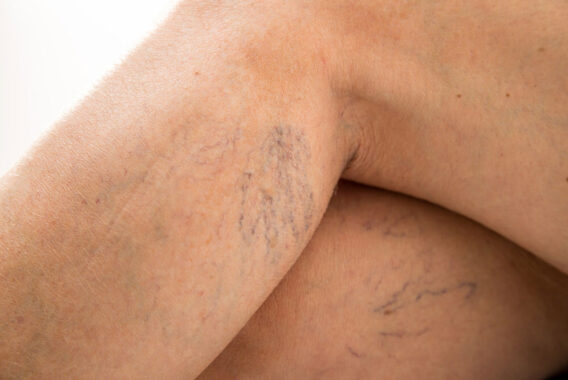 Treating Spider Veins: How do I Get the Best Results?