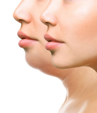 Reducing Double Chins: The Top 2 Treatments