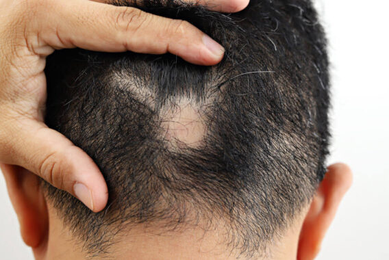 What Are the Early Signs of Alopecia?