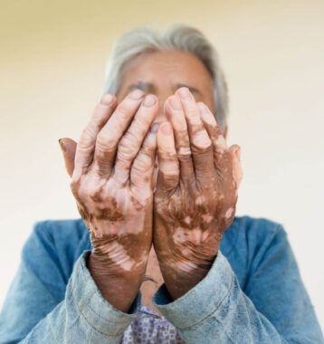 Vitiligo: Finding Results Through Light Therapy