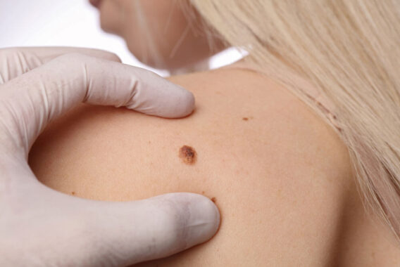 When Should I Seek a Doctor’s Opinion About My Mole?