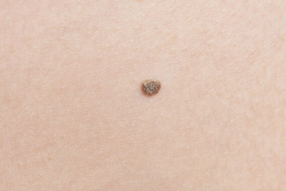 Skin Cancer Awareness Month: The 3 Biggest Things to Watch For