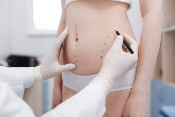 The Pros and Cons: CoolSculpting vs. Liposuction for Weight Loss