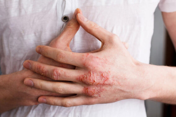 Identifying Eczema and Treating Dermatitis