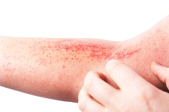 Eczema: Protecting Your Skin from Infection, Cracking, and Discomfort