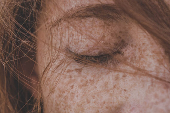 Forget About Freckles: Treatment Options