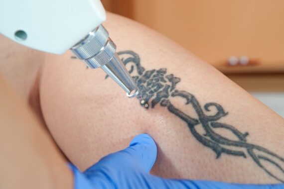 Laser Therapy: From Stretch Mark to Tattoo Removal