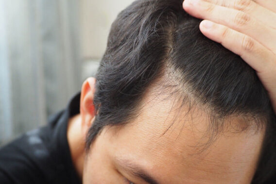Beware of Hair Loss Product and Treatment Scams