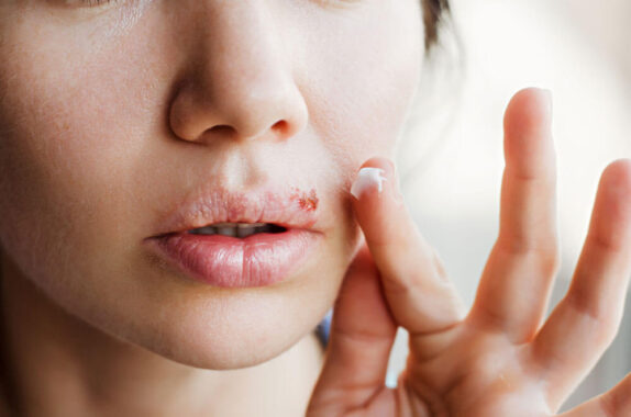 Herpes: Treating Cold Sores and Other Symptoms