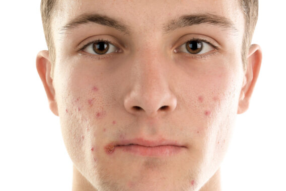How Will a Dermatologist Help with My Acne Problem?