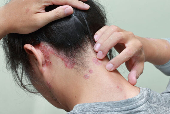 Need a Lesion Removed from Your Scalp? Consider Mohs Surgery