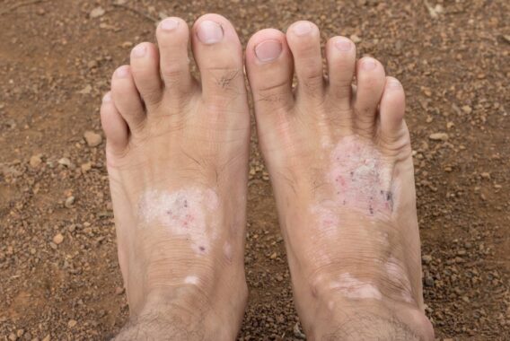 Here Are the Top Most Common Fungal Infections