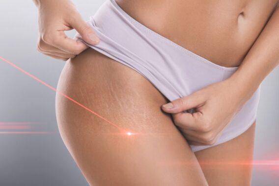 How to Be Proactive with Your Stretch Marks