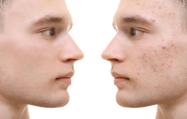 How to Reduce Acne and Restore Confidence with Cosmetic Treatments