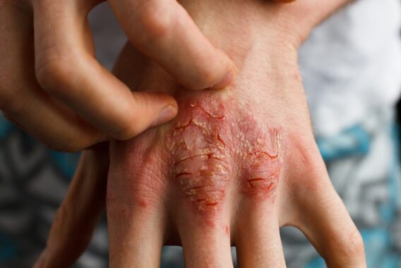 From Severe to Mild Psoriasis, We Can Help You