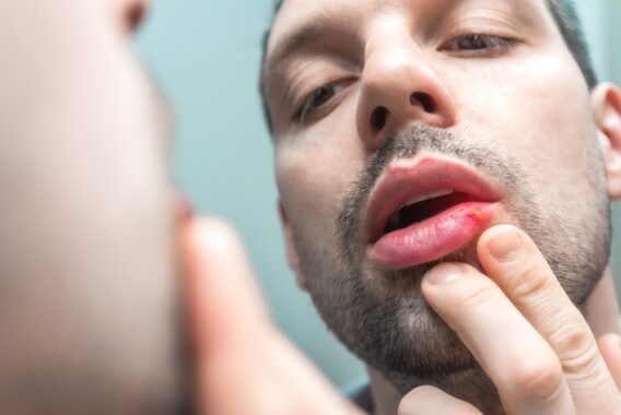 Steps to Take when Having a Herpes Outbreak