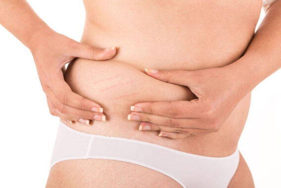 The Latest Laser Technology for Stretch Mark Removal