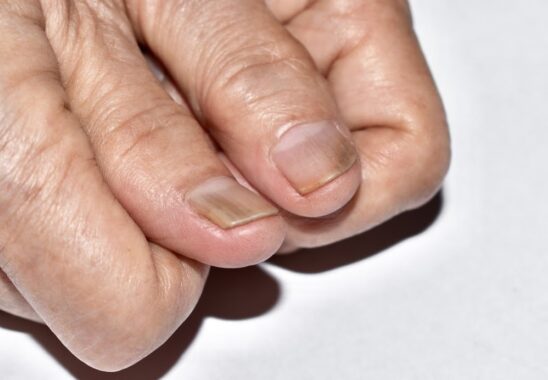 Here’s Why You May Be Suffering from Nail Abnormalities