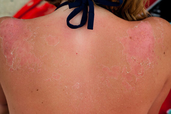 The Top 4 Tips for Sunburn Recovery