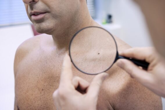 What Areas of the Body Are Most Prone to Skin Cancer?