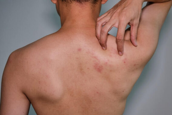 What Causes Hives in the Winter?