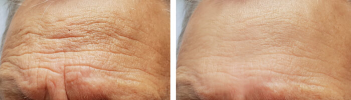 Wrinkles: Which Is Better: Botox or Dermal Fillers?