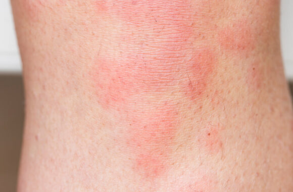 What Are Some Dermatological Cures for Hives?