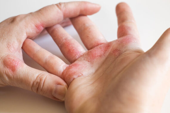 Is There Really a Long-Term Cure for Eczema?