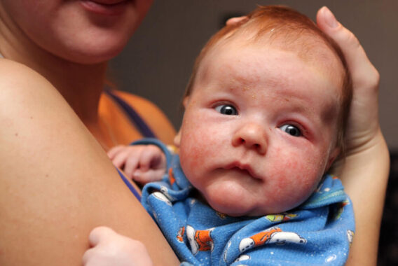 How to Soothe Eczema in Children and Babies