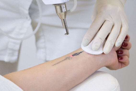 What You Should Know Before Your Tattoo Removal