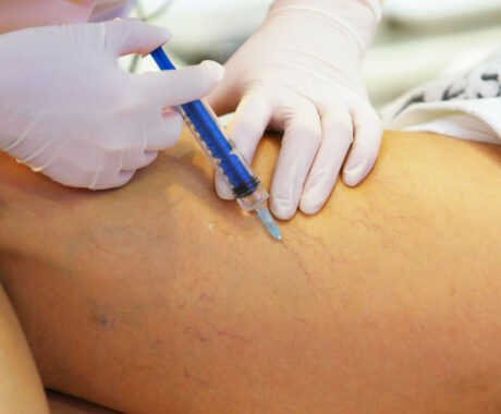 How to Prepare for Your Sclerotherapy Treatments