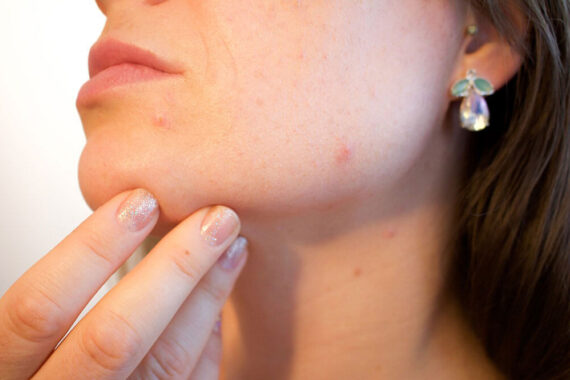 Why Light-Based Therapy Will Be Your Most Successful Acne Laser Treatment