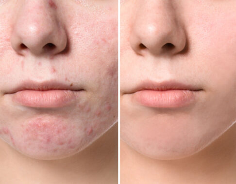 Want Acne Gone Without Scarring? Your Dermatologist Can Help