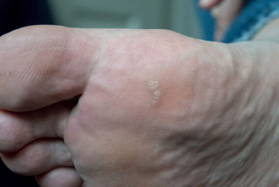 What Causes Warts and How to Treat Them