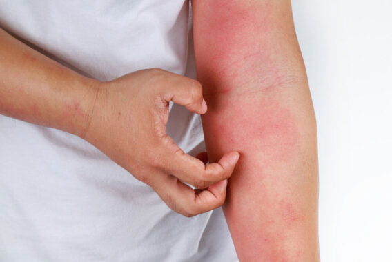 Do Common Rashes and Rosacea Have Different Treatments?