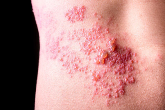 What You Should Know About Shingles