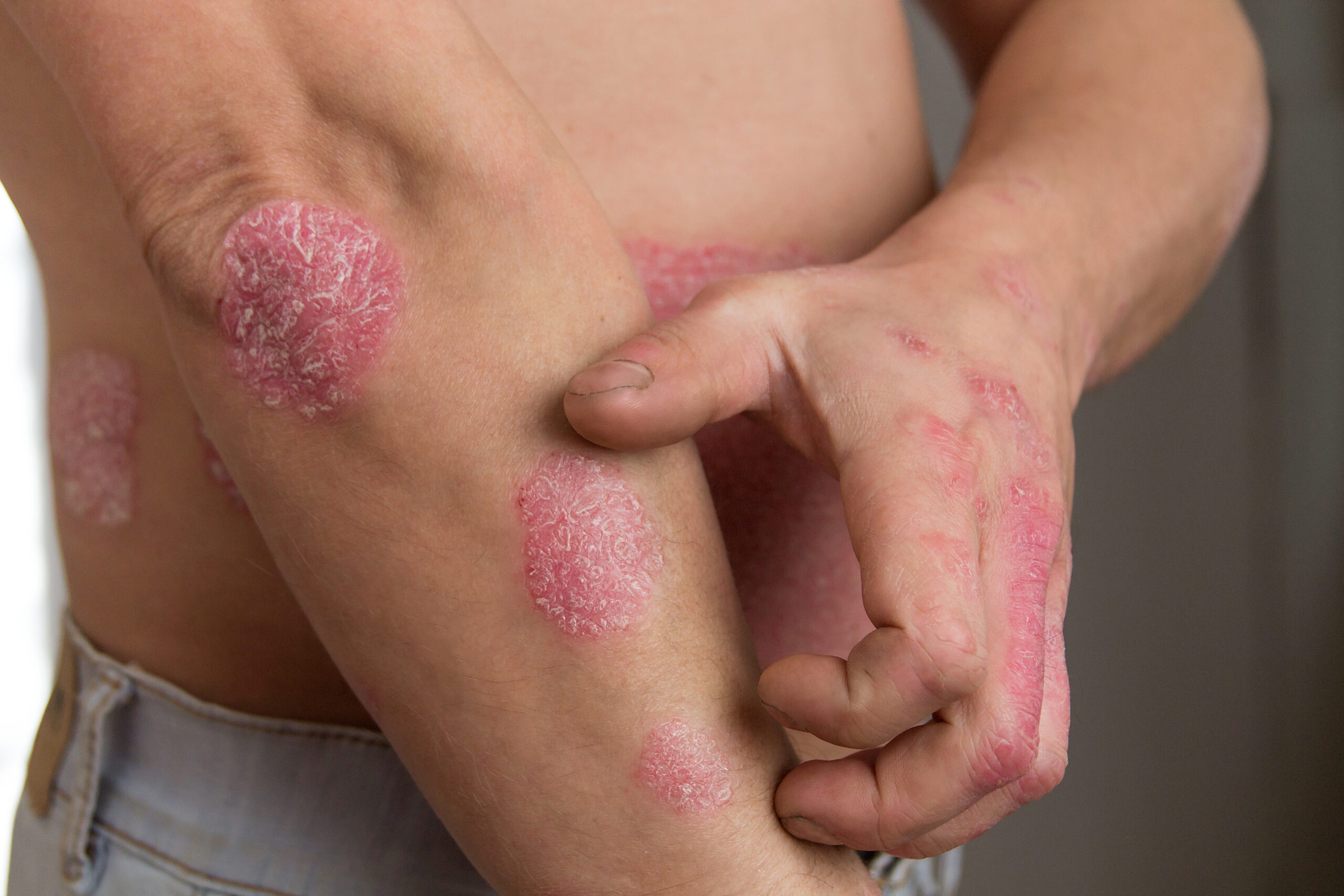 August is Psoriasis Awareness Month!