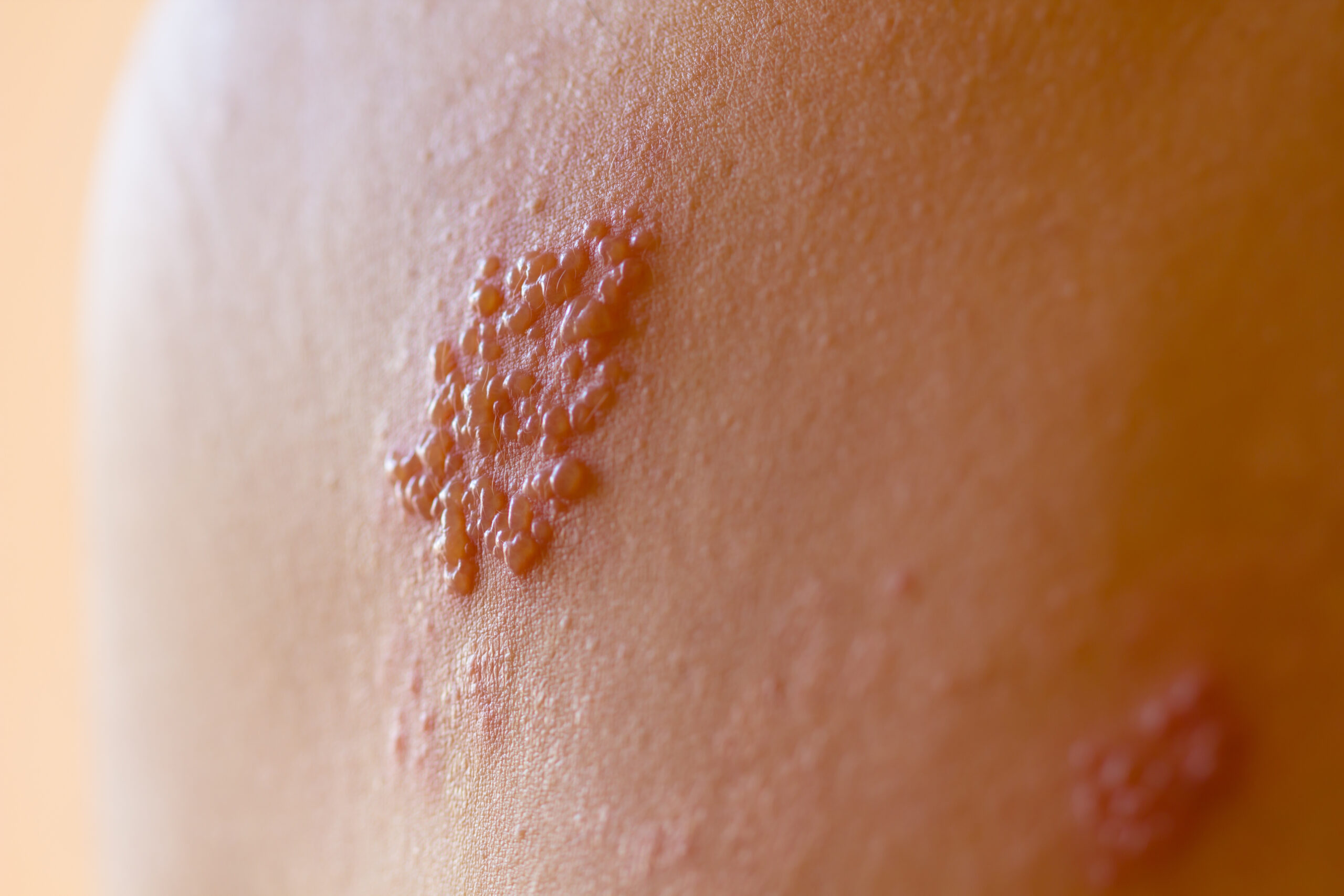 Shingles