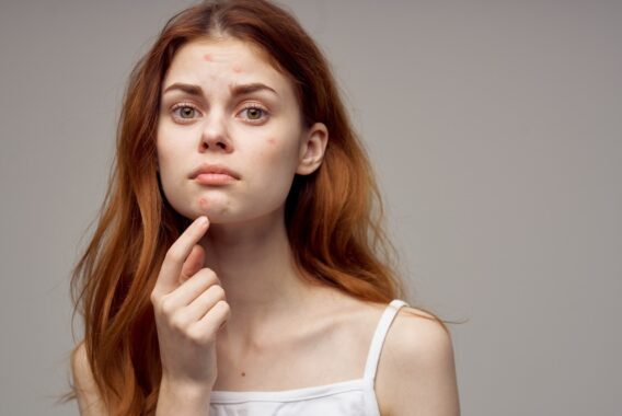 Cystic Acne: Your Treatment Options Explained
