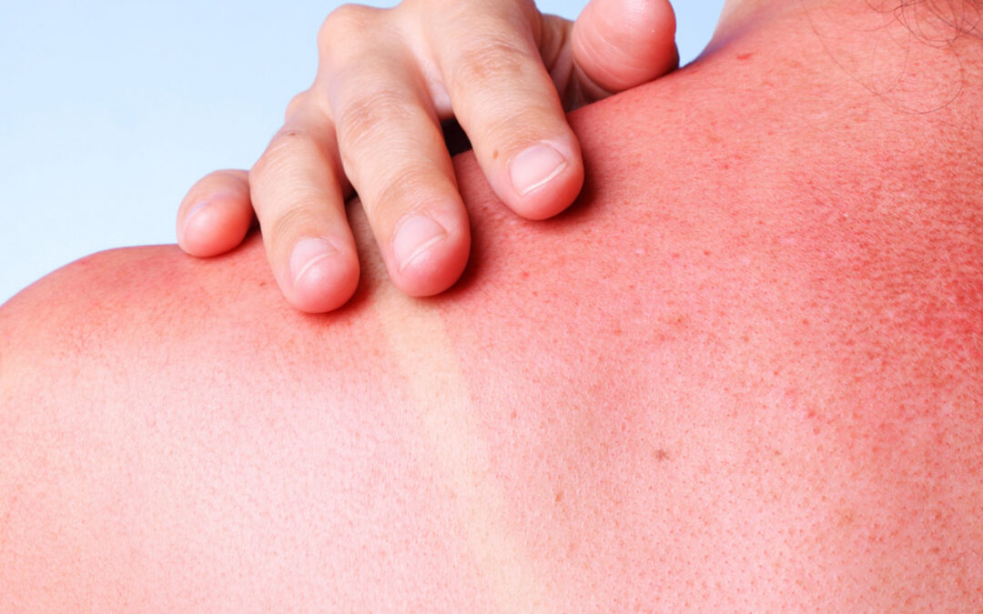 How to Choose the Right Sunscreen for Your Skin Type
